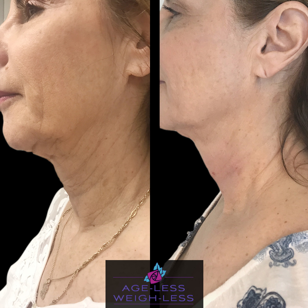 Jawline Enhancement Treatment Before and After Photos | Age less Weigh Less | Woburn, MA & Dover, NH