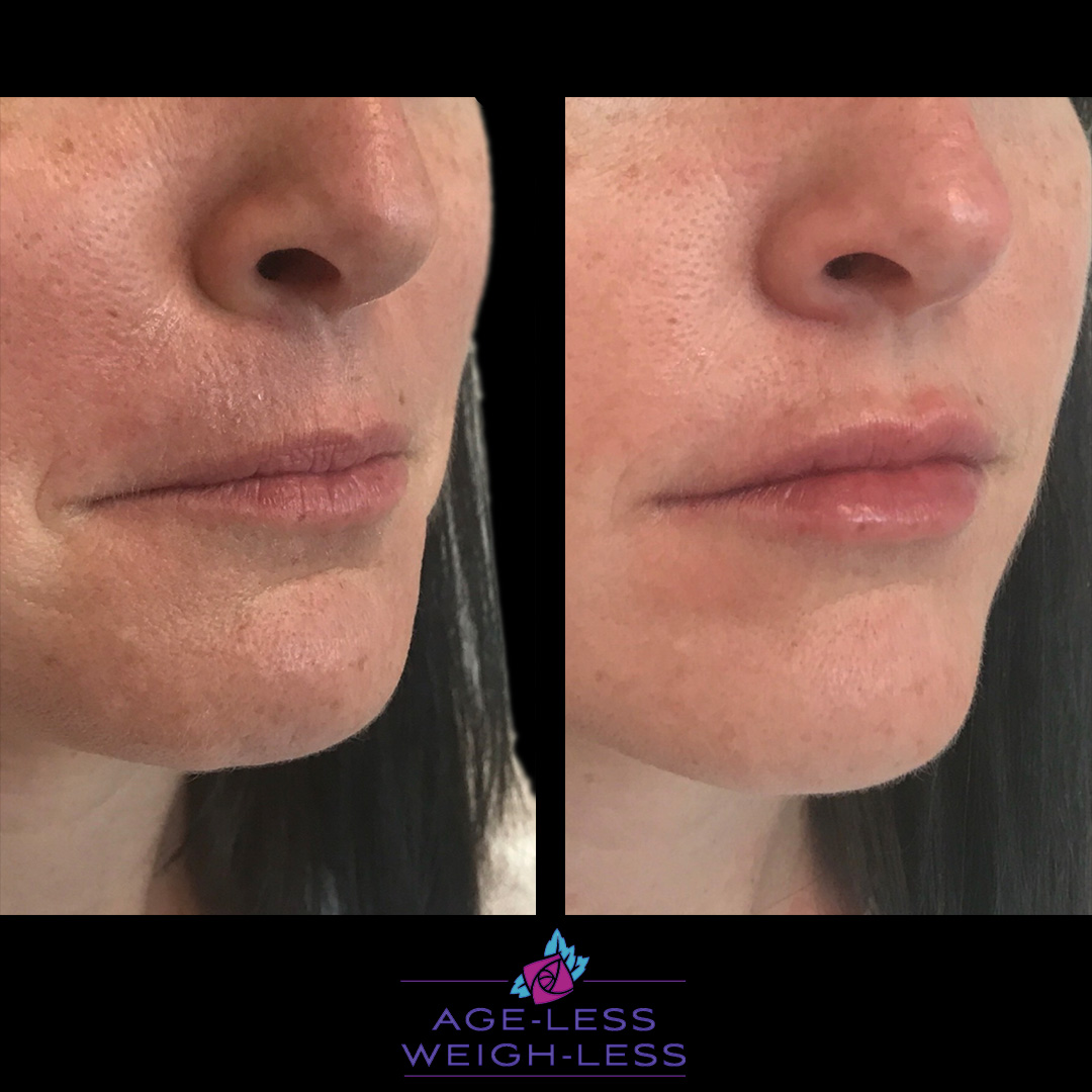 Lip Filler Treatment Before and After Photos | Age less Weigh Less | Woburn, MA & Dover, NH