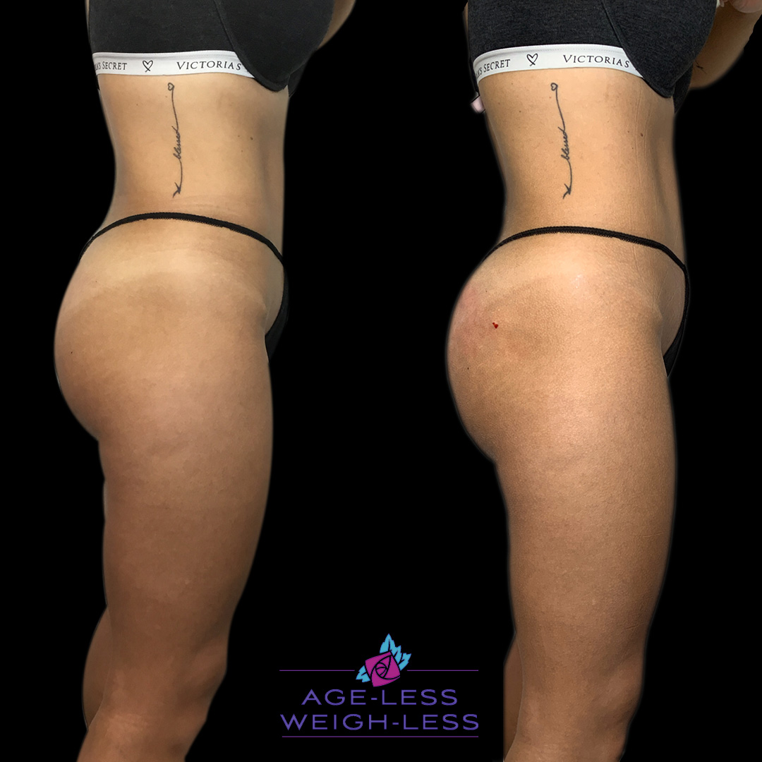 Butt Lift Treatment Before and After Photos | Age less Weigh Less | Woburn, MA & Dover, NH