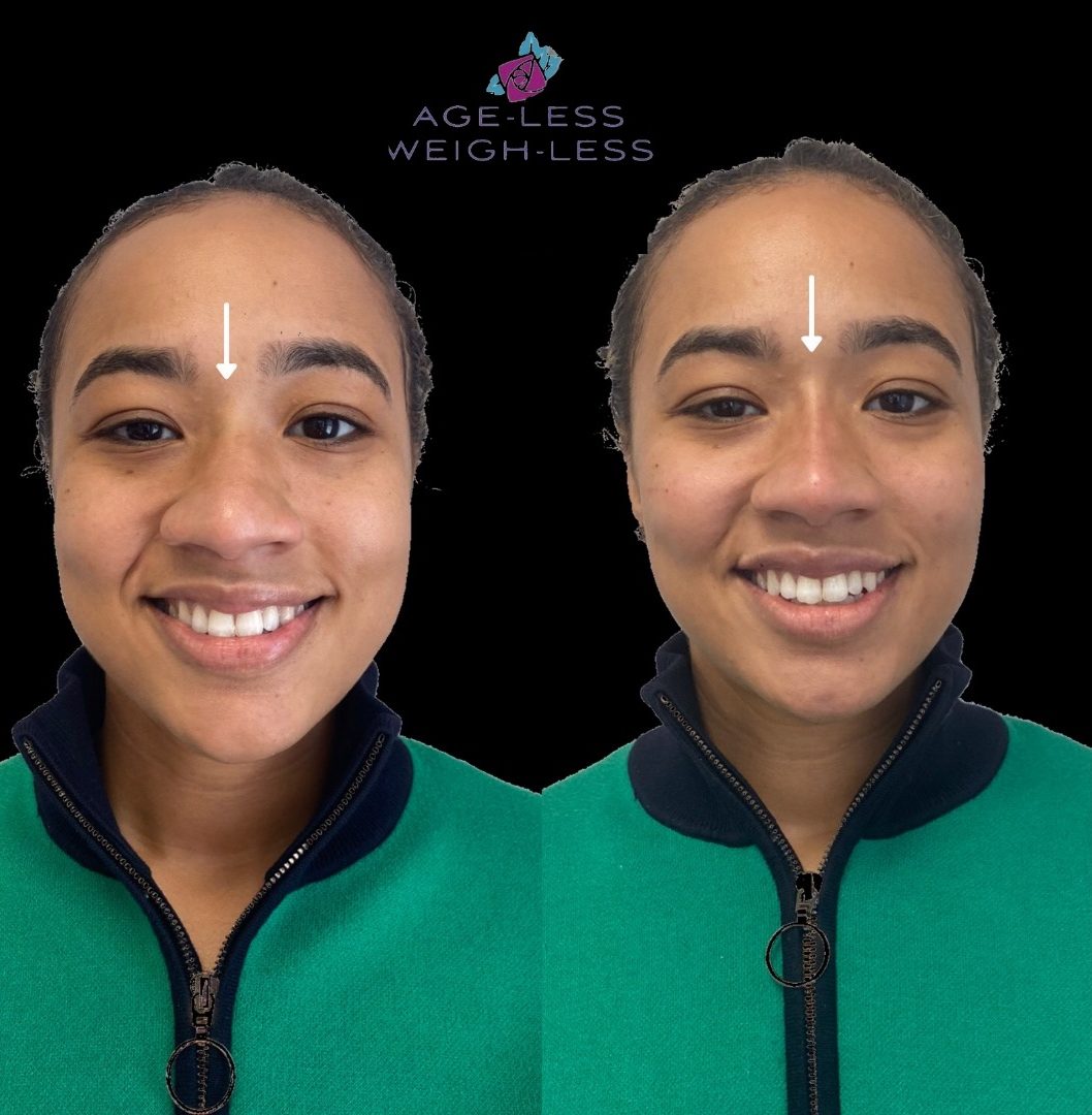 Non-Surgical Nose Job Treatment Before and After Photos | Age less Weigh Less | Woburn, MA & Dover, NH