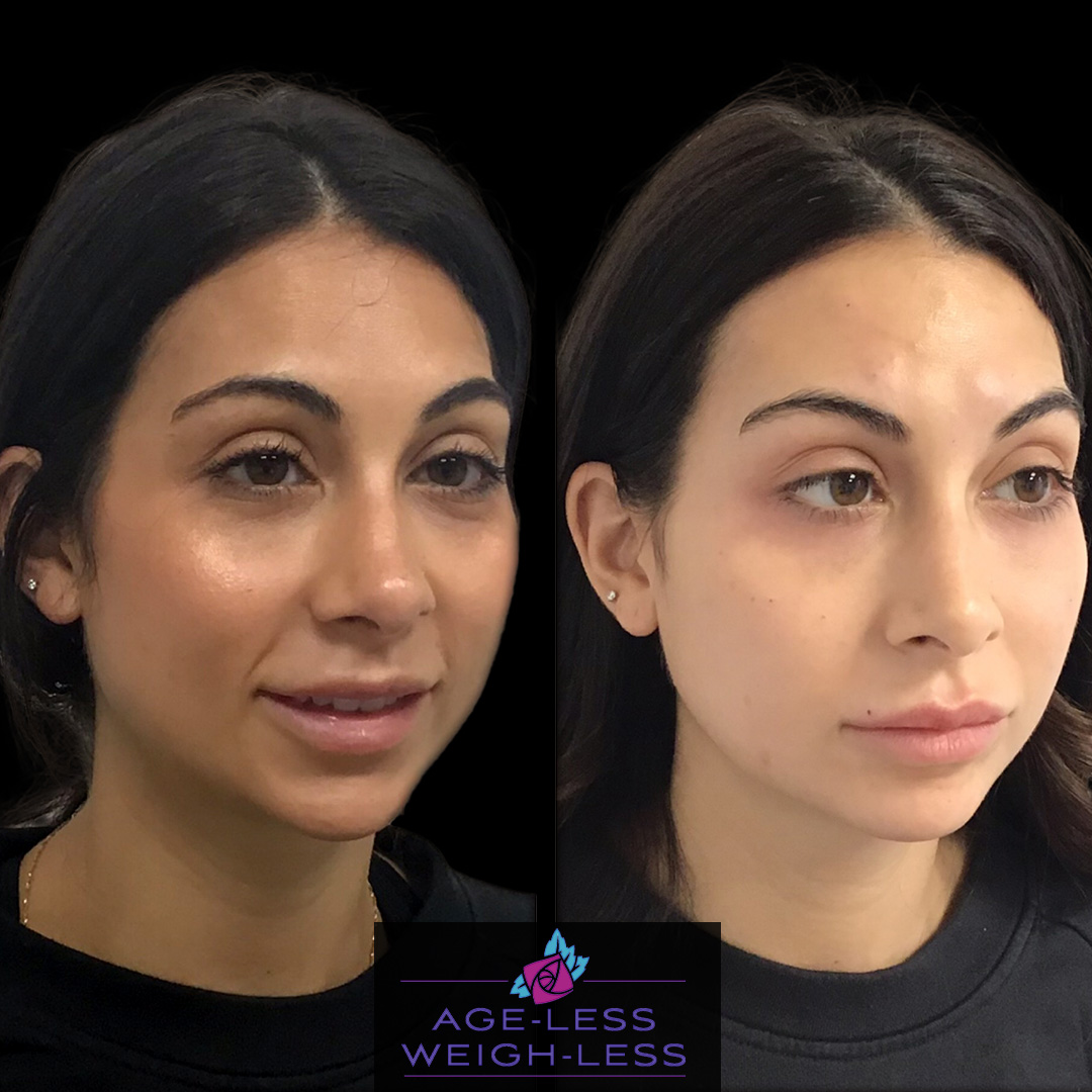 Under Eye filler Treatment Before and After Photos | Age less Weigh Less | Woburn, MA & Dover, NH