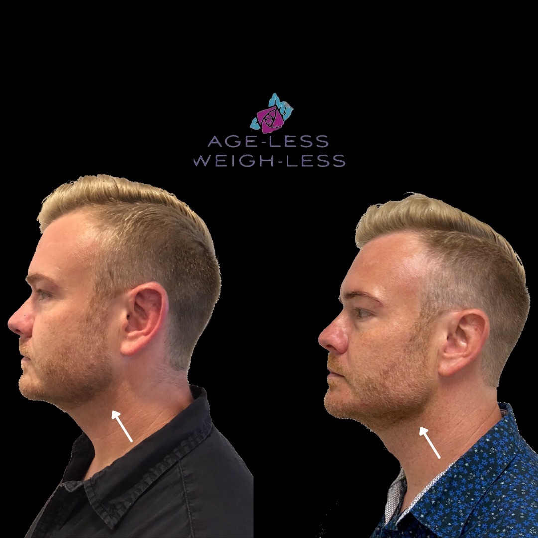 Men Jawline Filler Treatment Before and After Photos | Age less Weigh Less | Woburn, MA & Dover, NH