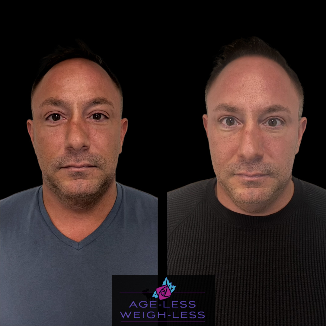 Men Rejuvenation Before and After Treatment Photos | Age less Weigh Less | Woburn, MA & Dover, NH