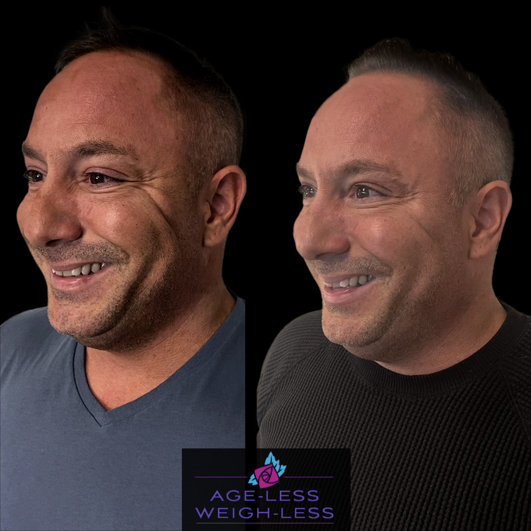 Botox For Men Before and After Treatment Photos | Age less Weigh Less | Woburn, MA & Dover, NH