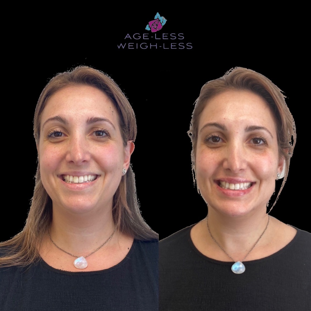 Dermal Filler Treatment Before and After Photos | Age less Weigh Less | Woburn, MA & Dover, NH