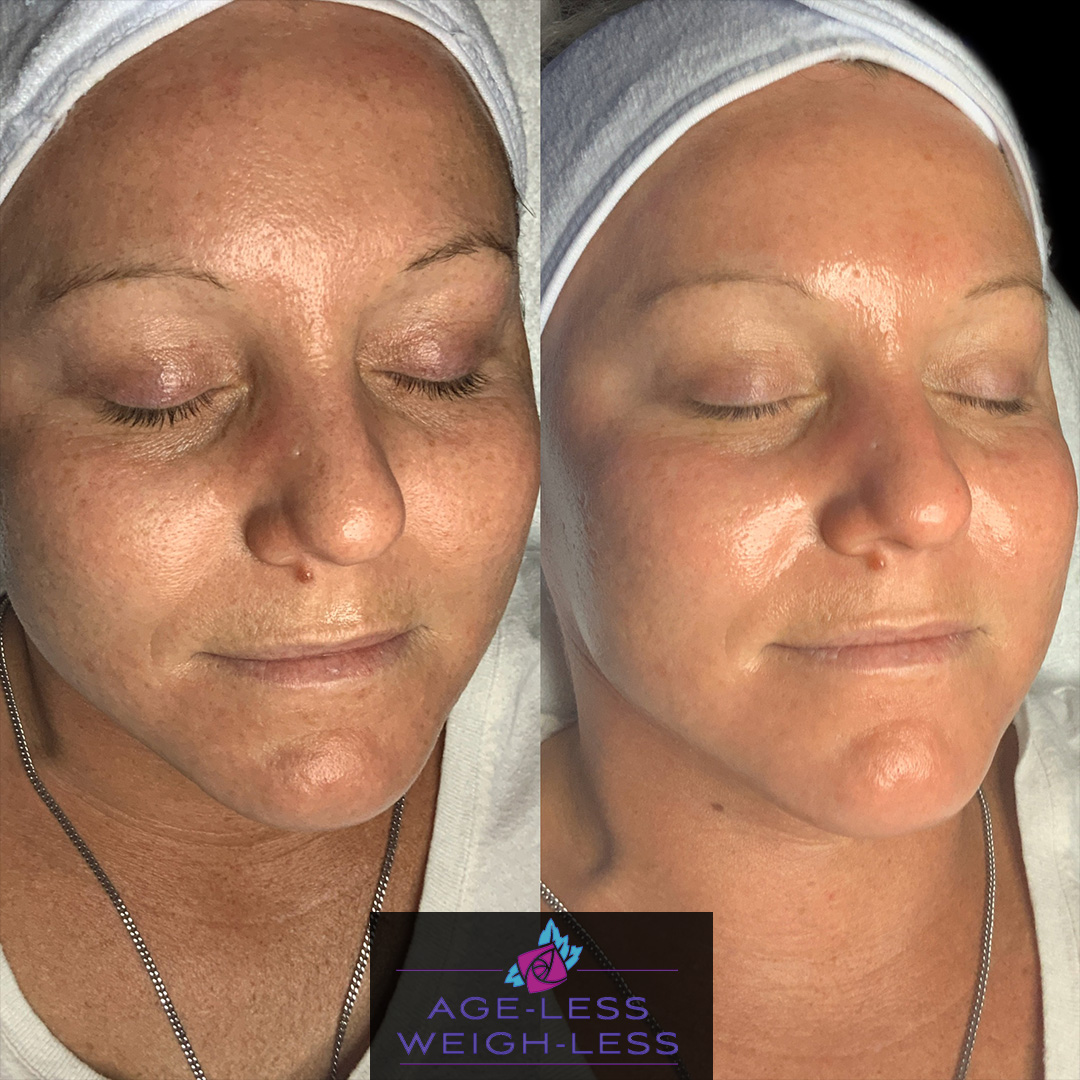 Intense Pulse Laser Before and After Photos | Age less Weigh Less | Woburn, MA & Dover, NH