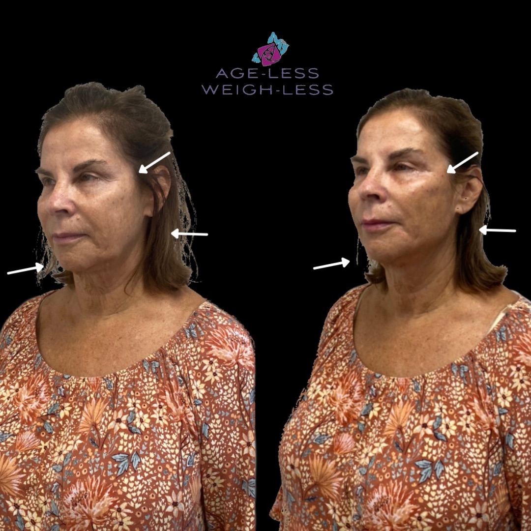 Dermal Filler Treatment Before and After Photos | Age less Weigh Less | Woburn, MA & Dover, NH