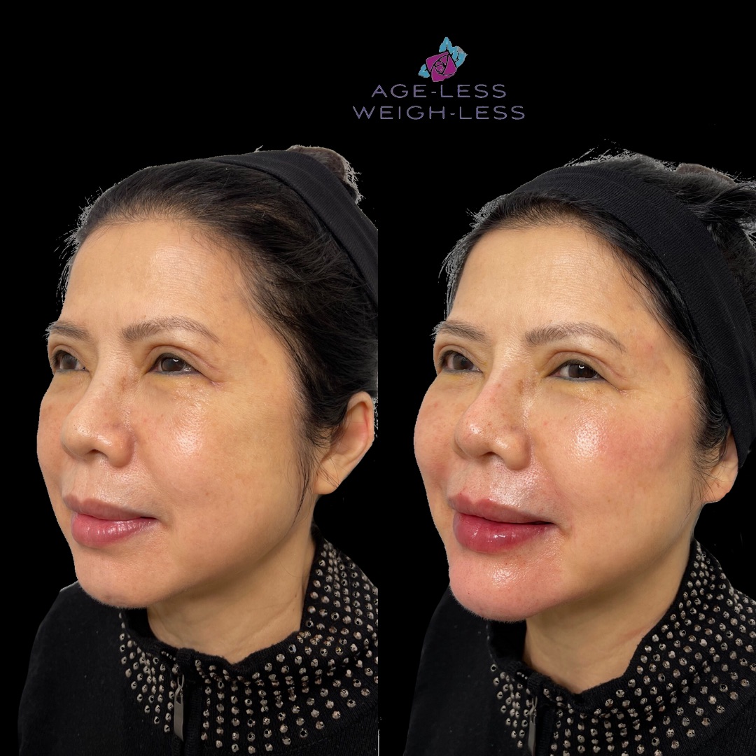 Filler Treatments Before and After Photos | Age less Weigh Less | Woburn, MA & Dover, NH