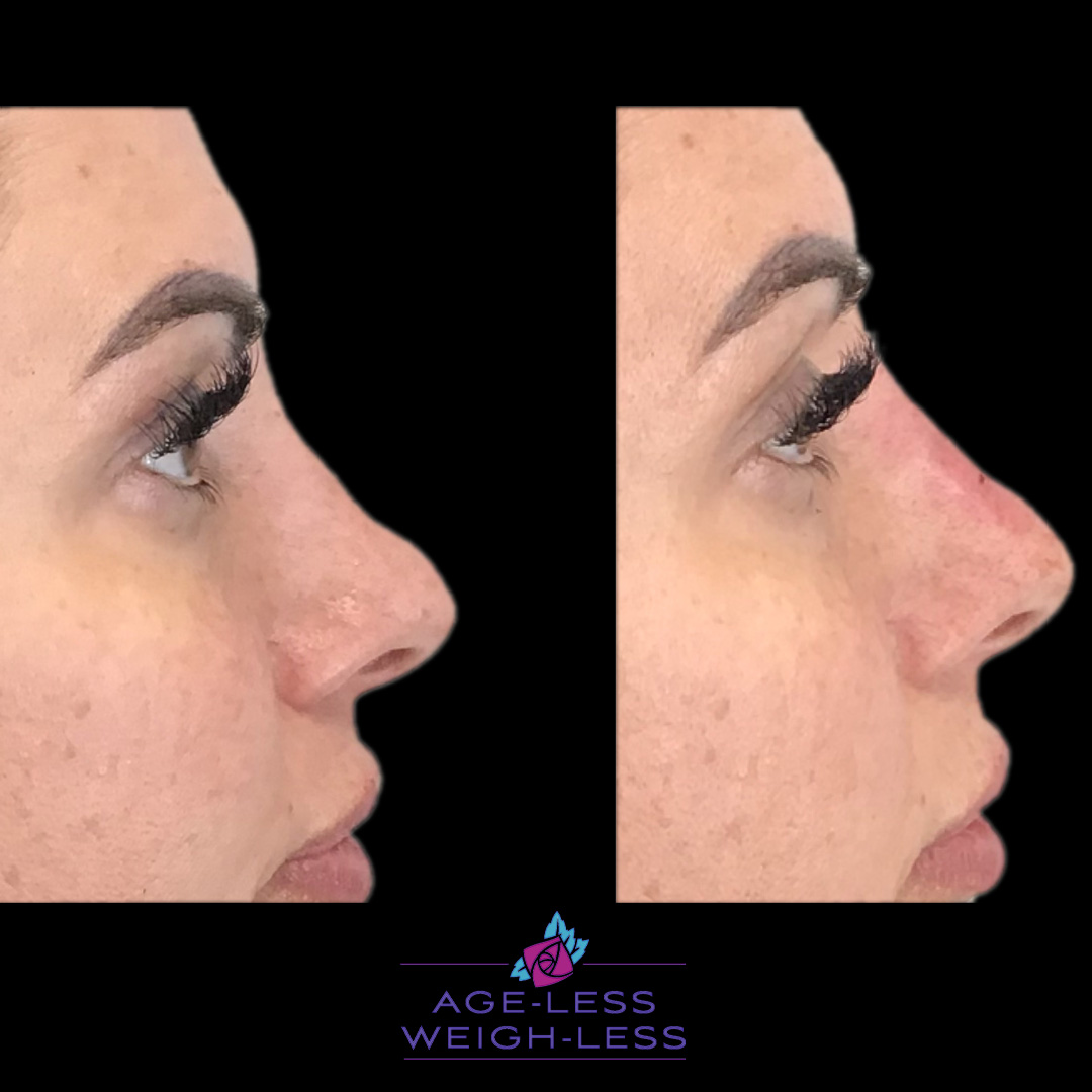 Nose Treatment Before and After Photos | Woburn, MA & Dover, NH | Age less Weigh Less