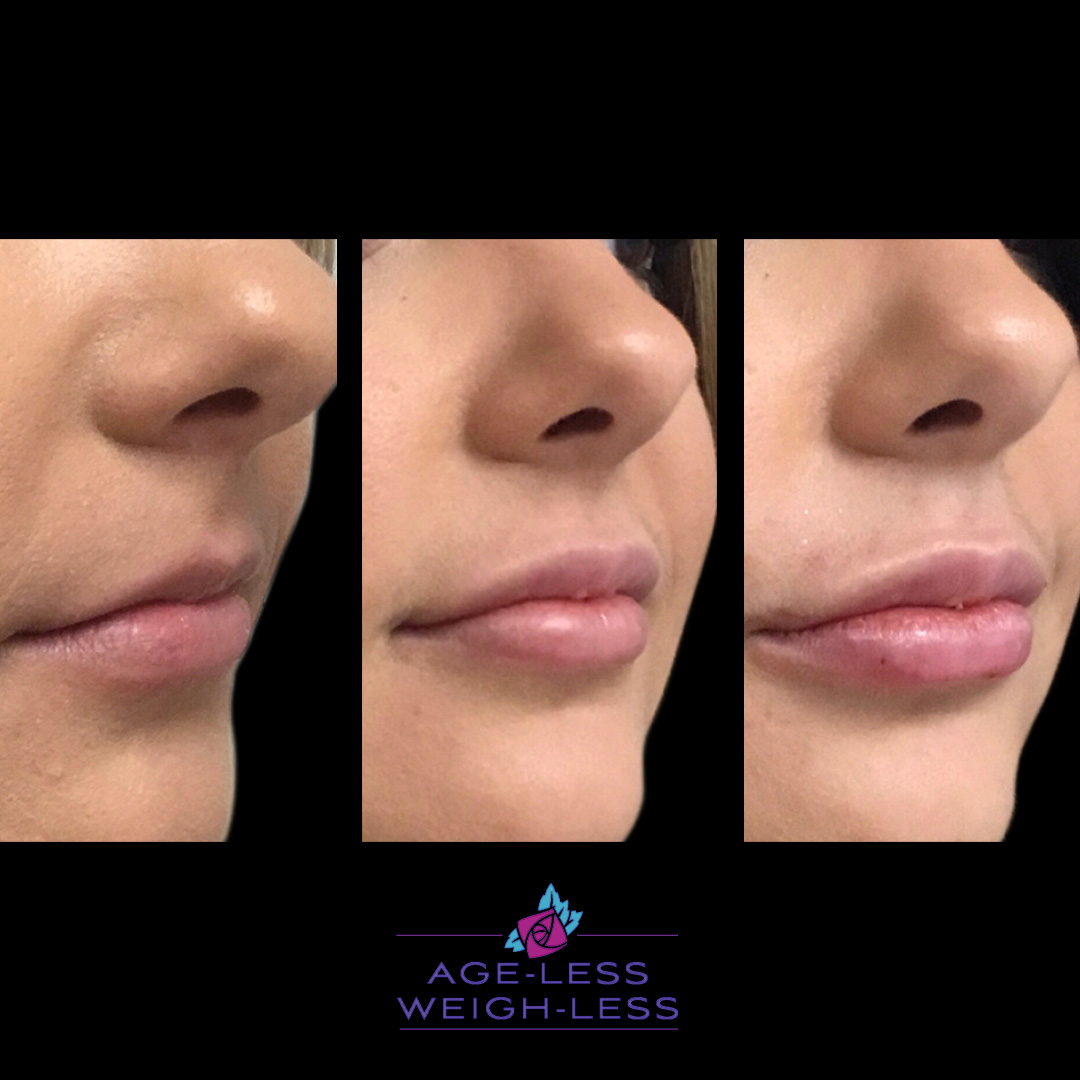 Lip Filler Treatment Before and After Photos | Woburn, MA & Dover, NH | Age less Weigh Less