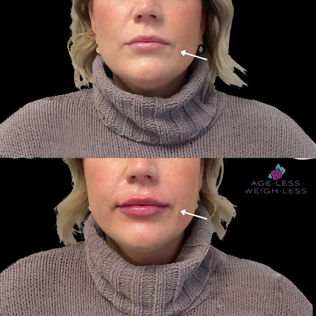 Filler Treatments Before and After Photos | Age less Weigh Less | Woburn, MA & Dover, NH