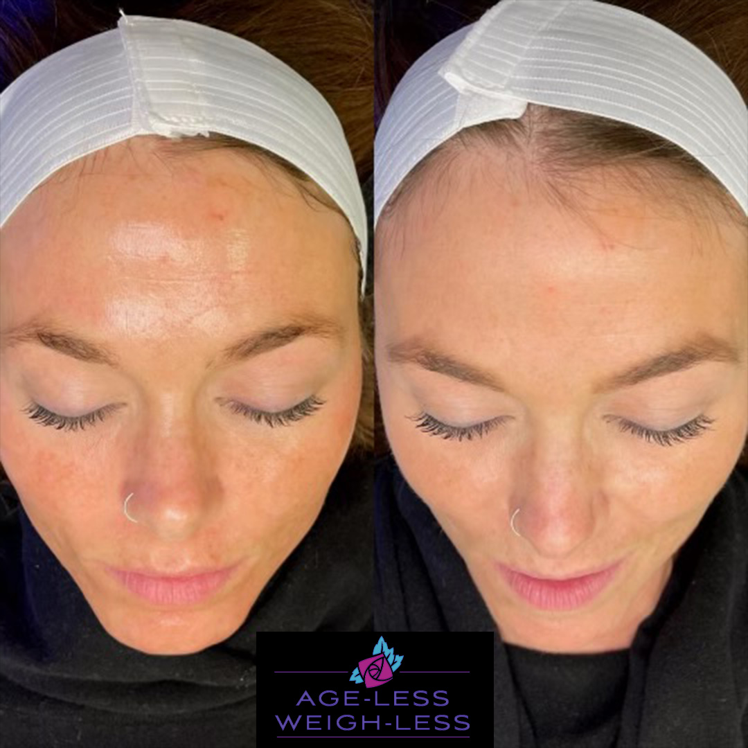 Glow Up Treatments - Before and after Treatment images from medspa in Dover and Woburn - Age Less Weigh Less