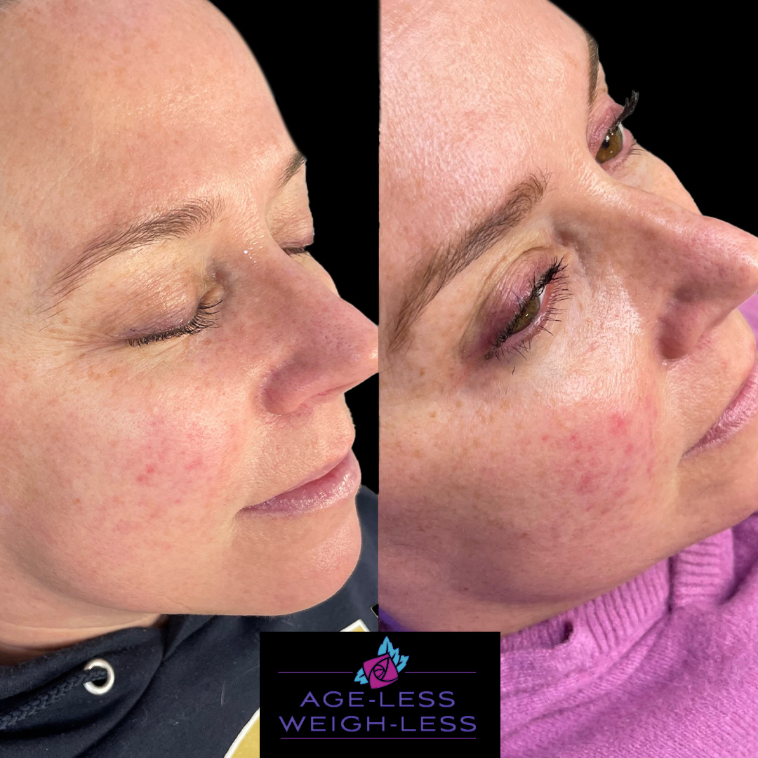Glow Up Treatments - Before and after Treatment images from medspa in Dover and Woburn - Age Less Weigh Less