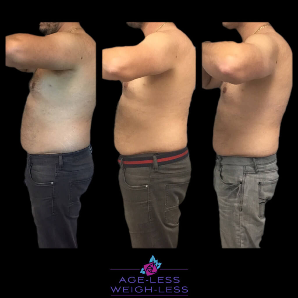 Coolsculpting Before and after Treatment Photos | Woburn, MA & Dover, NH | Age Less Weigh Less