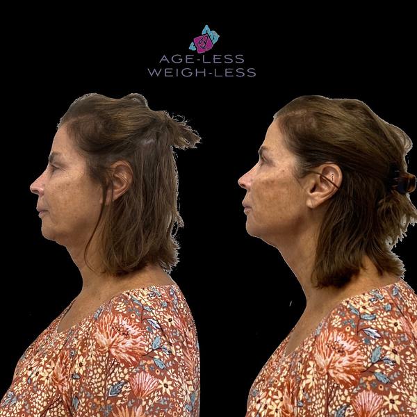 Jawline Enhancement | Woburn, MA & Dover, NH | Age less Weigh Less