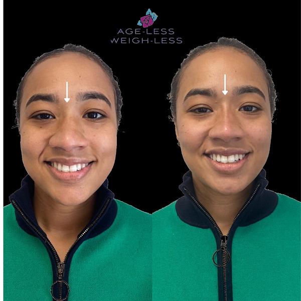 Non-Surgical Nose Job | Woburn, MA & Dover, NH | Age less Weigh Less