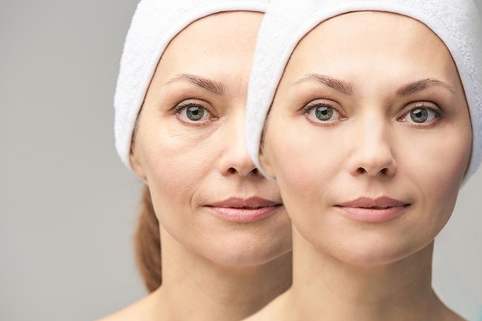 Under Eye Filler Female | Woburn, MA & Dover, NH | Age Less Weigh Less